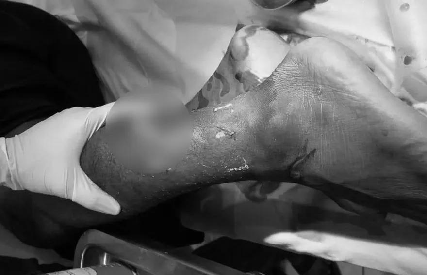 މިޔަރެއްގެ ހަމަލާގައި ފަތުރުވެރިއެެއްގެ ފައިބުރިކޮށްލައިފި